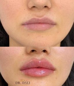 dr.dali-acid-hialuronic-2