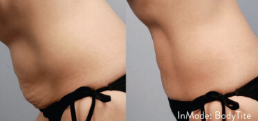 bodytite constanta dr dali3