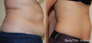 bodytite constanta dr dali5