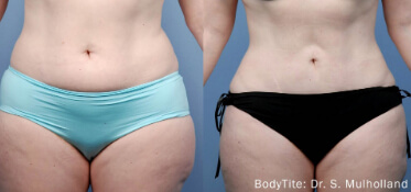 bodytite constanta dr dali6