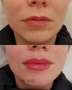 marire buze constanta 22