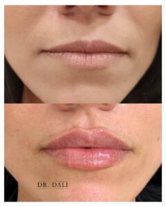 marire buze constanta 23