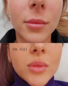 marire buze constanta 24